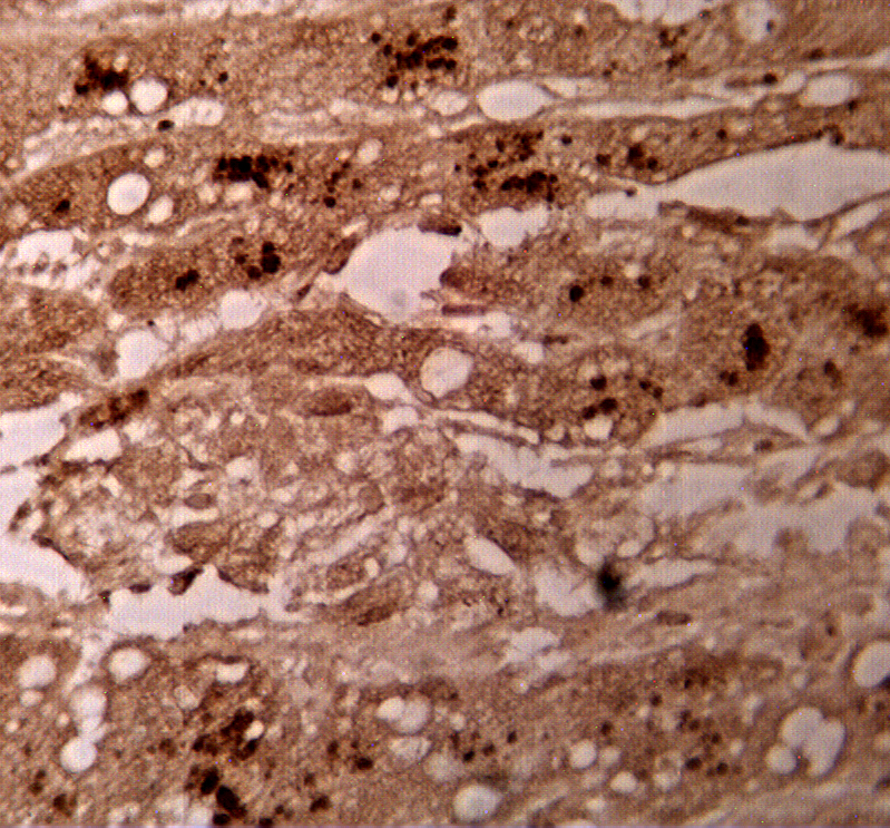 "
Immunohistochemical staining using GPC3 antibody (Cat. No. X2395P) on human hepatocellular carcinoma tissue.  Antibody used at 10 µg/ml.  Secondary antibody, HRP conjugated mouse anti-sheep (Cat. No. X1206M), used at 1:20 dilution.  Sections heated for 10 minutes with 10 mM sodium citrate.  "